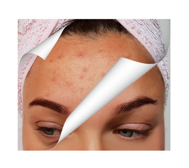 Microdermabrasion vs. Microneedling: Which is Better for Acne Scars?