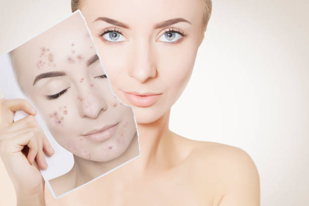 microdermabrasion versus micro needling