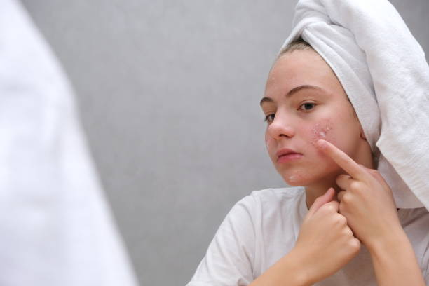 microdermabrasion or microneedling
